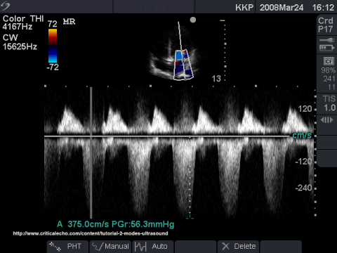 Continuous Doppler Ultrasound